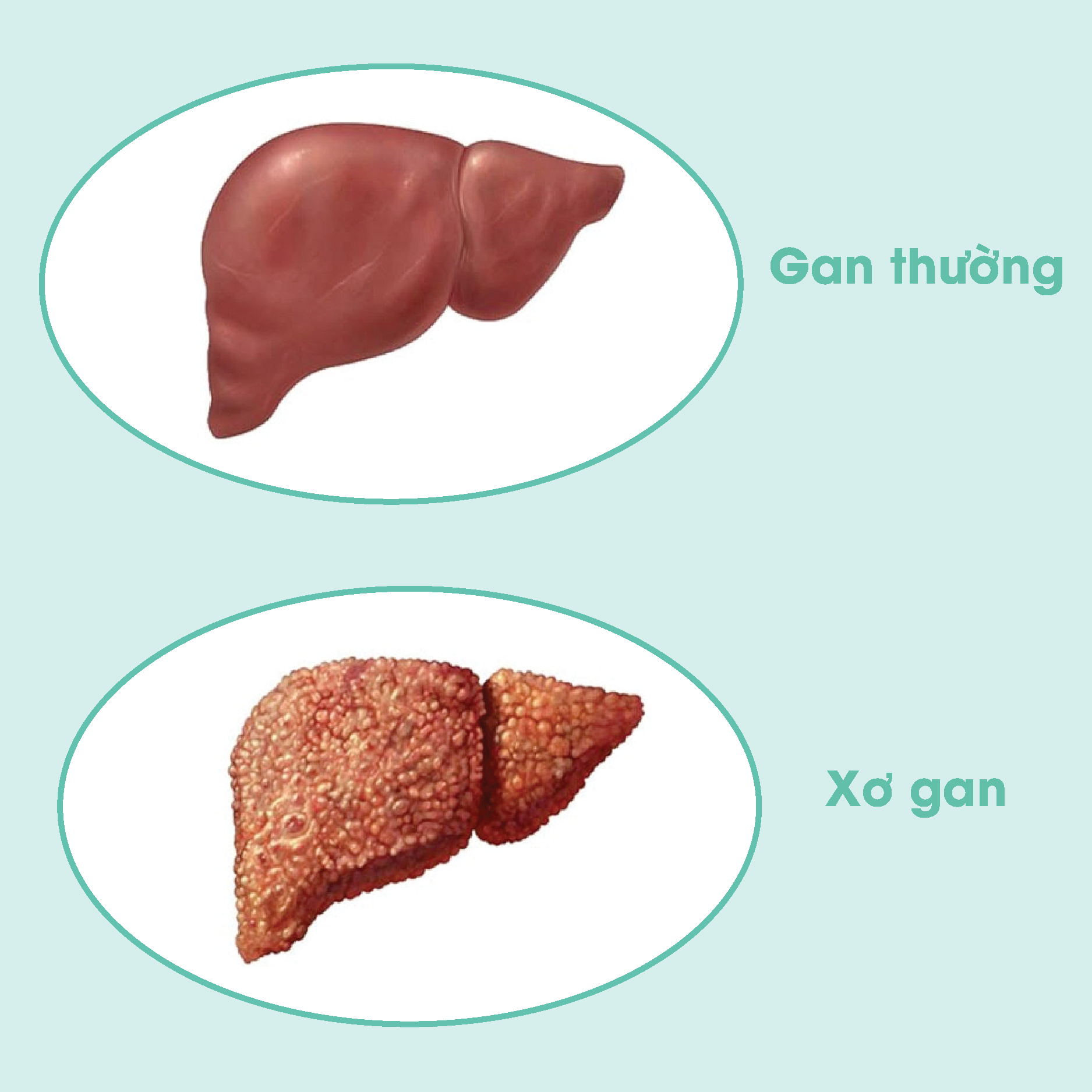 Gan thường - xơ gan